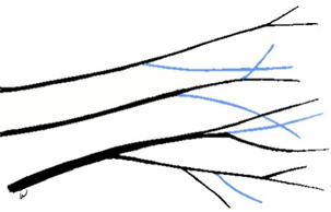 Line drawing showing three branches in black and blue. Small branches that are parallell to each other are shown in blue, which indicates they should be pruned to thin the tree. 